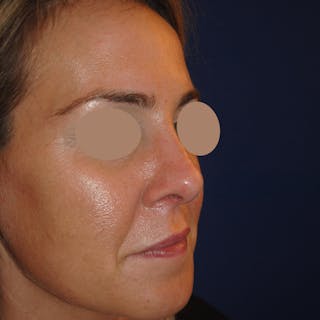 Rhinoplasty Before & After Gallery - Patient 250167 - Image 4