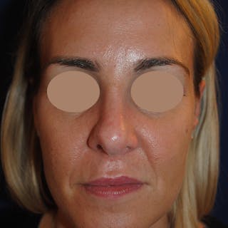 Rhinoplasty Before & After Gallery - Patient 250167 - Image 2