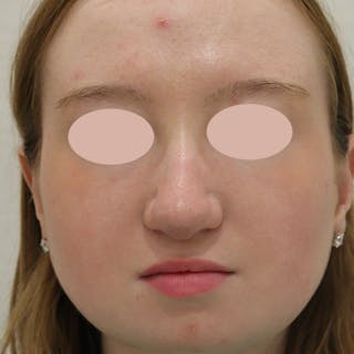 Rhinoplasty Before & After Gallery - Patient 145441 - Image 2