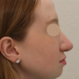 Rhinoplasty Before & After Gallery - Patient 145441 - Image 6
