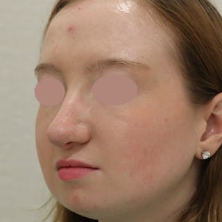 Rhinoplasty Before & After Gallery - Patient 145441 - Image 4