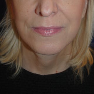 Facelift/Mini Facelift Before & After Gallery - Patient 272316 - Image 2