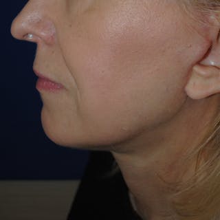 Facelift/Mini Facelift Before & After Gallery - Patient 272316 - Image 6
