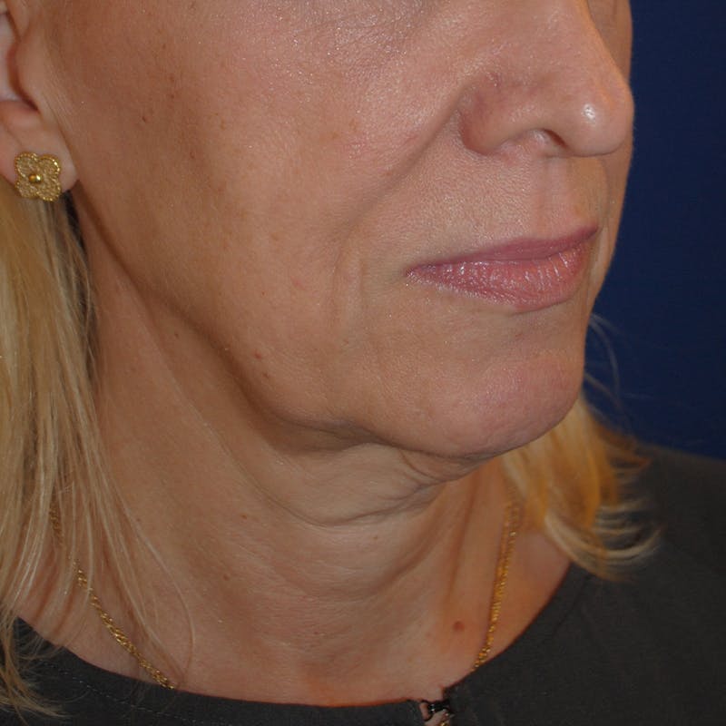 Facelift/Mini Facelift Before & After Gallery - Patient 272316 - Image 3