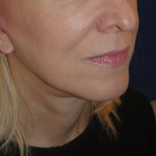 Facelift/Mini Facelift Before & After Gallery - Patient 272316 - Image 4