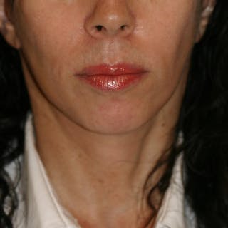 Facelift/Mini Facelift Before & After Gallery - Patient 202070 - Image 2