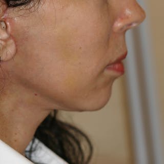 Facelift/Mini Facelift Before & After Gallery - Patient 202070 - Image 4