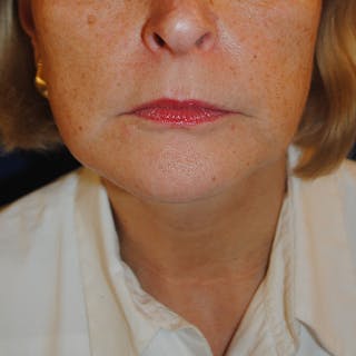 Facelift/Mini Facelift Before & After Gallery - Patient 168974 - Image 2