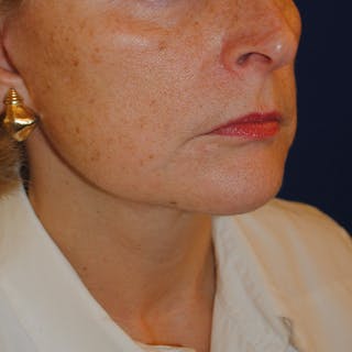 Facelift/Mini Facelift Before & After Gallery - Patient 168974 - Image 4