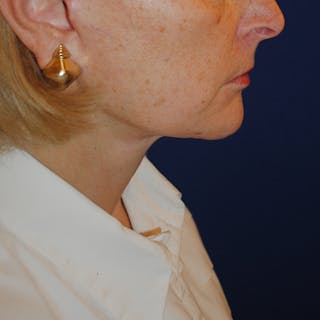Facelift/Mini Facelift Before & After Gallery - Patient 168974 - Image 6