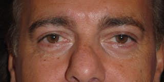 Eyelid Surgery Before & After Gallery - Patient 364560 - Image 2