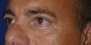 Eyelid Surgery Before & After Gallery - Patient 364560 - Image 4