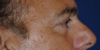 Eyelid Surgery Before & After Gallery - Patient 364560 - Image 6