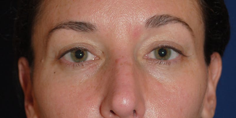 Eyelid Surgery Before & After Gallery - Patient 399000 - Image 2