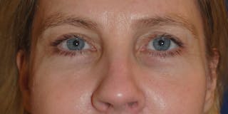 Eyelid Surgery Before & After Gallery - Patient 142403 - Image 2