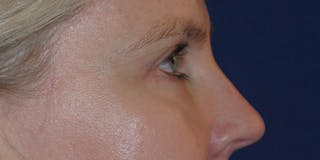 Eyelid Surgery Before & After Gallery - Patient 142403 - Image 4