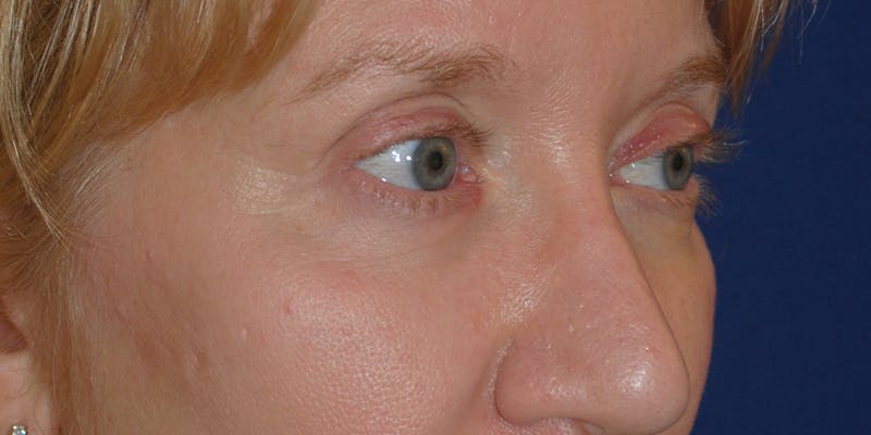 Eyelid Surgery Before & After Gallery - Patient 241341 - Image 1