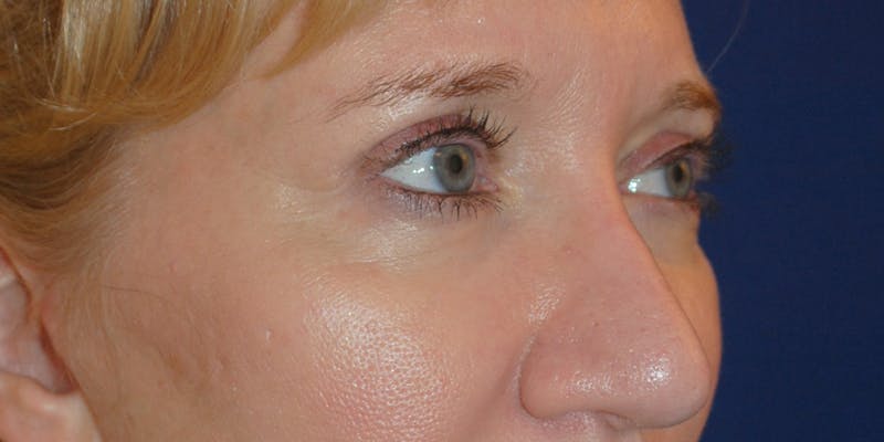 Eyelid Surgery Before & After Gallery - Patient 241341 - Image 2