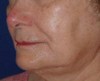 Mohs Surgery Before & After Gallery - Patient 504927 - Image 4