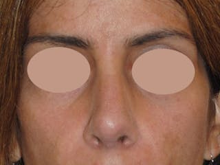 Revision Rhinoplasty Before & After Gallery - Patient 230490 - Image 2