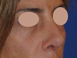 Revision Rhinoplasty Before & After Gallery - Patient 230490 - Image 4