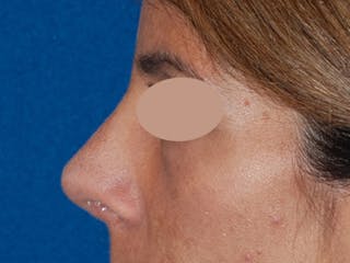 Revision Rhinoplasty Before & After Gallery - Patient 230490 - Image 6