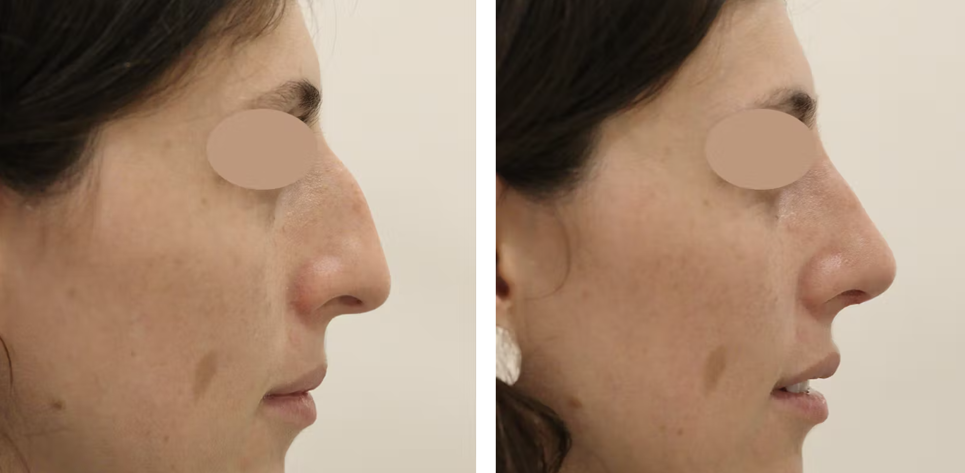 rhinoplasty before and after