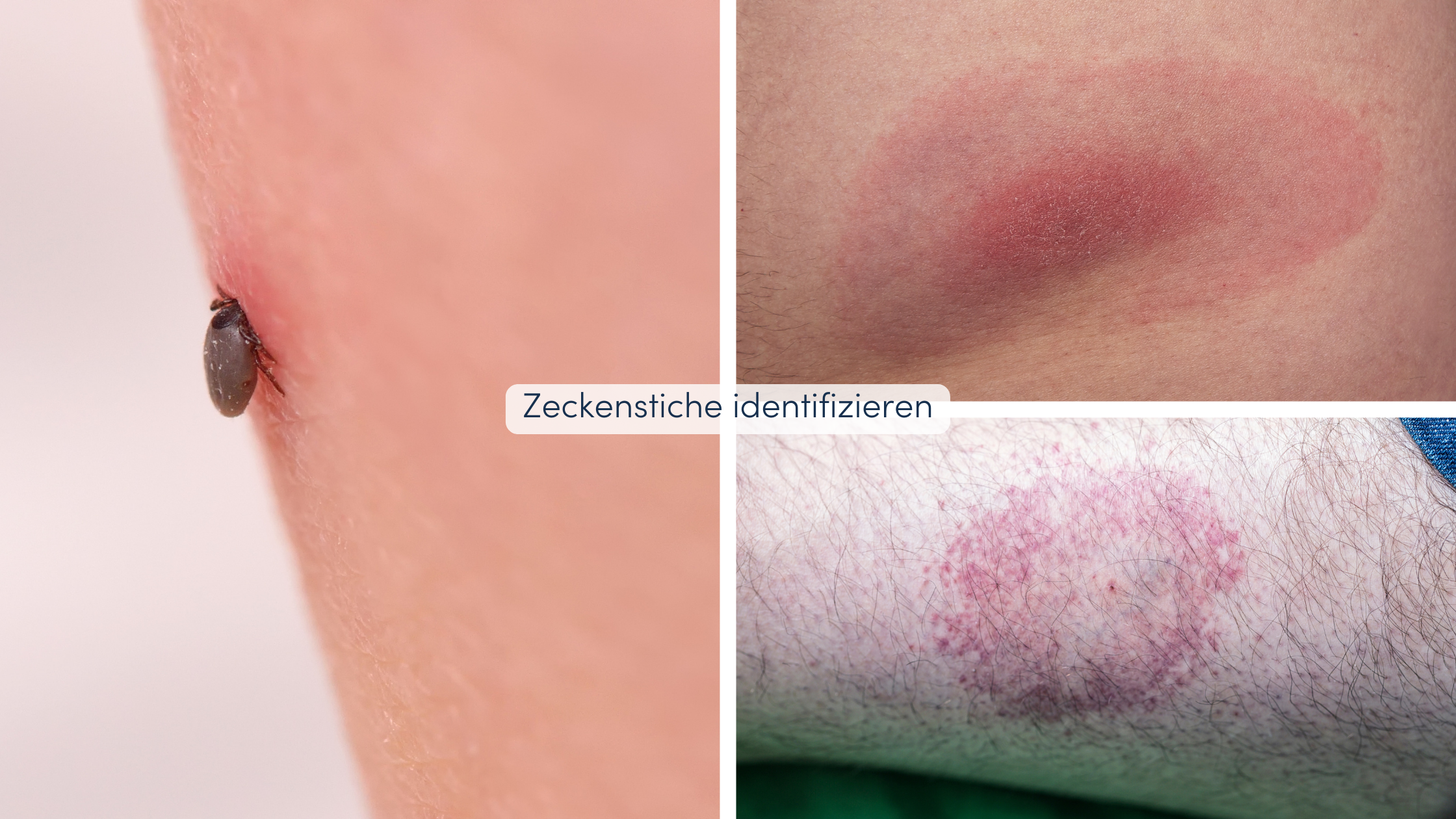 Insektenstiche unterscheiden Zeckenstiche identifizieren