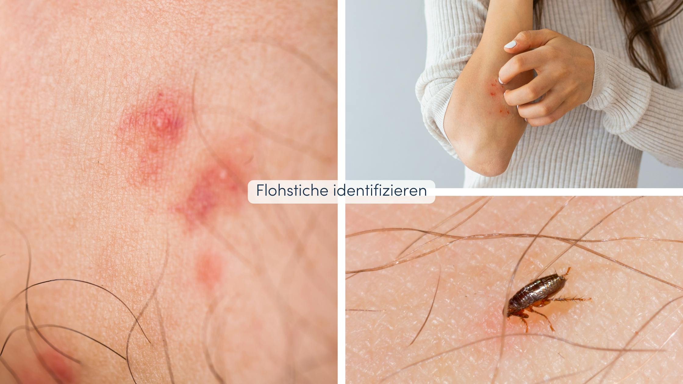 Insektenstiche unterscheiden: Erkennungsmerkmale und Symptome