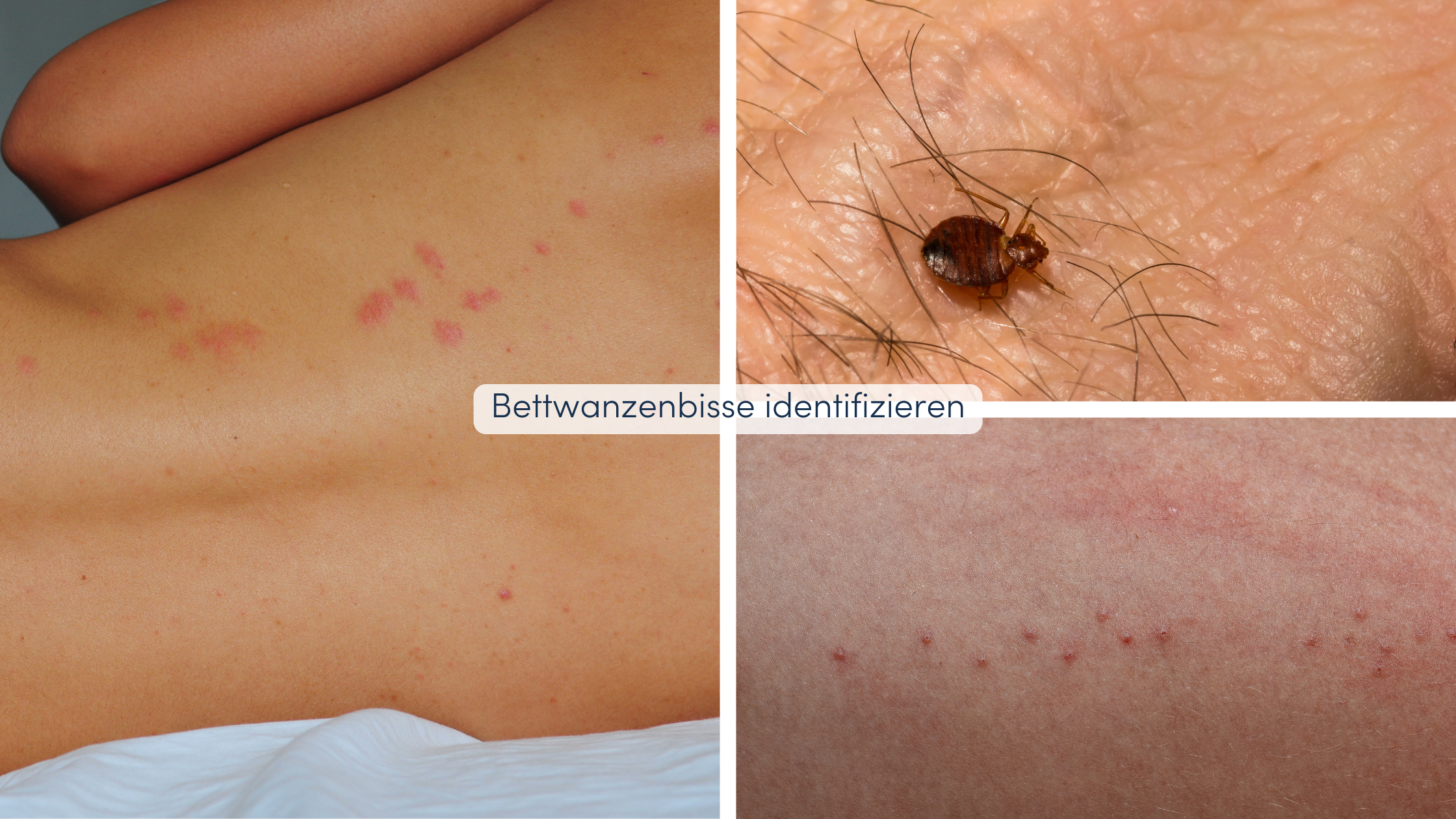 Insektenstiche unterscheiden Bettwanzenbisse identifizieren