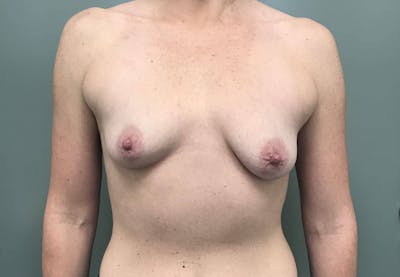 Breast Augmentation Before & After Gallery - Patient 282766 - Image 1