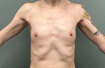 Breast Augmentation Before & After Gallery - Patient 241670 - Image 1