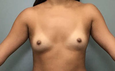 Breast Augmentation Before & After Gallery - Patient 349845 - Image 1