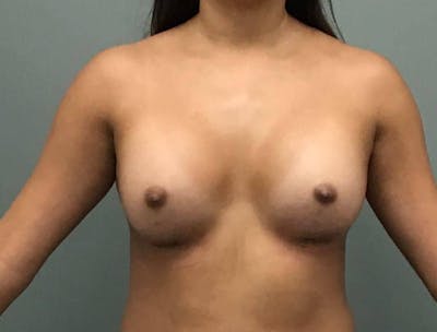 Breast Augmentation Before & After Gallery - Patient 349845 - Image 2