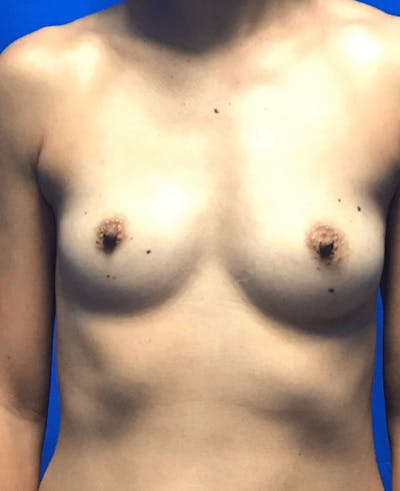 Breast Augmentation Before & After Gallery - Patient 104810 - Image 1