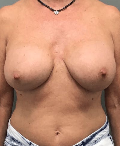 Breast Augmentation Before & After Gallery - Patient 713034 - Image 2