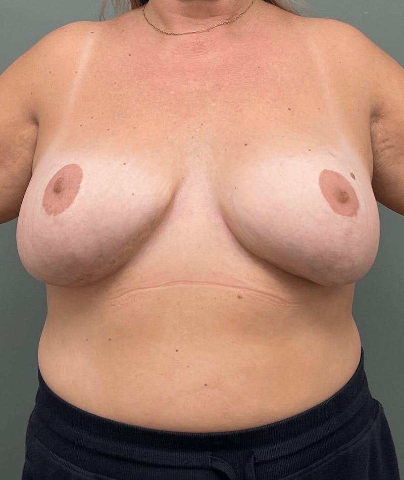 Breast Lift Before & After Gallery - Patient 227332 - Image 2