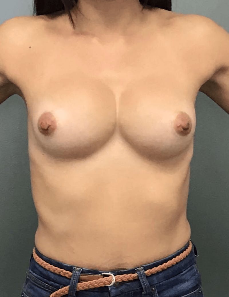 Breast Augmentation Before & After Gallery - Patient 340003 - Image 1