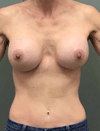 Breast Revision Before & After Gallery - Patient 678210 - Image 2