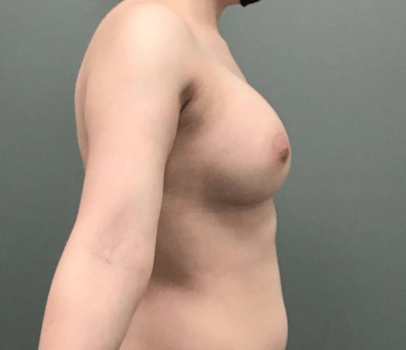 Breast Augmentation Before & After Gallery - Patient 404153 - Image 4