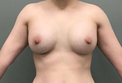 Breast Augmentation Before & After Gallery - Patient 404153 - Image 2