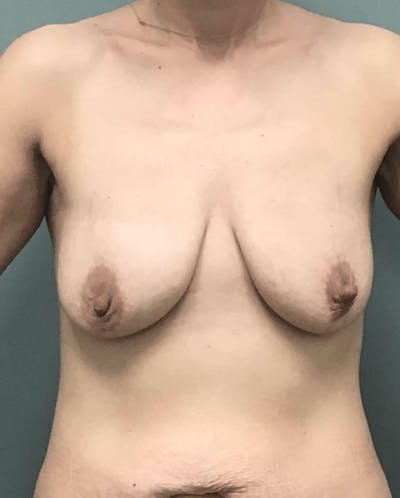 Breast Augmentation Before & After Gallery - Patient 258264 - Image 1