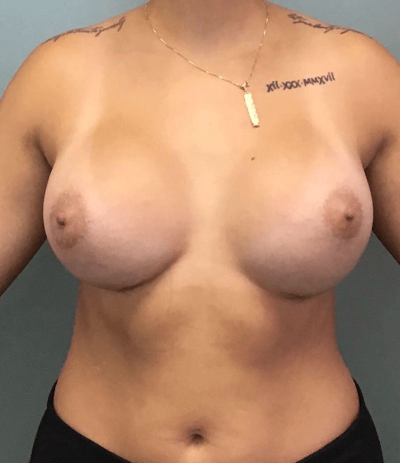 Breast Augmentation Before & After Gallery - Patient 218877 - Image 2