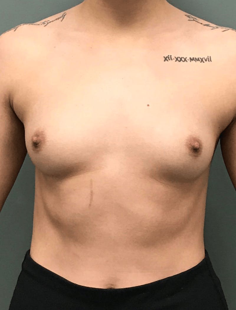 Breast Augmentation Before & After Gallery - Patient 218877 - Image 1