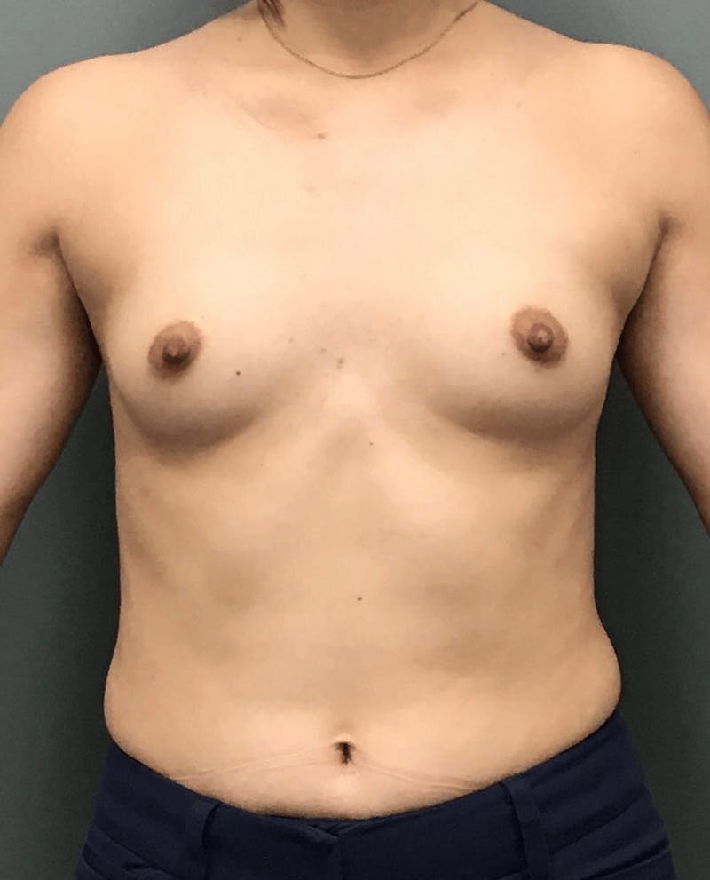 Breast Augmentation Before & After Gallery - Patient 151688 - Image 1