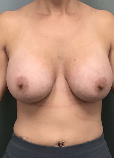 Breast Augmentation Before & After Gallery - Patient 164485 - Image 2