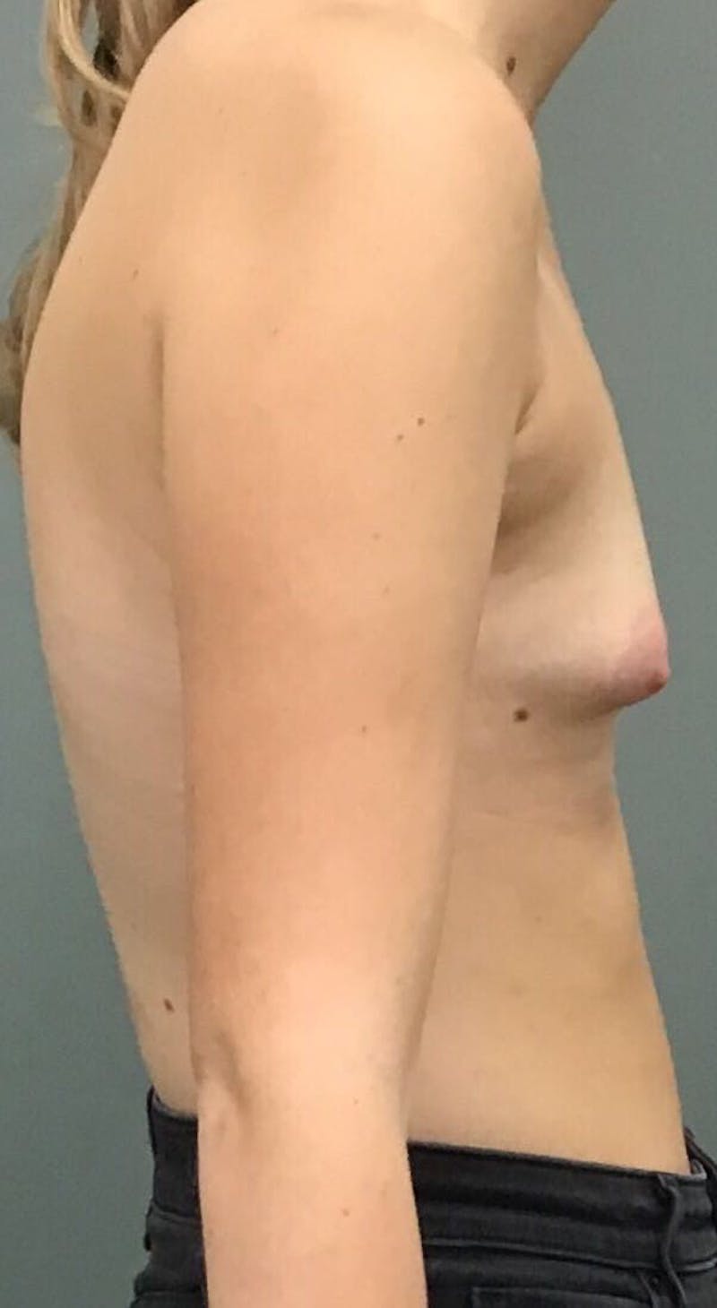 Breast Augmentation Before & After Gallery - Patient 137227 - Image 3