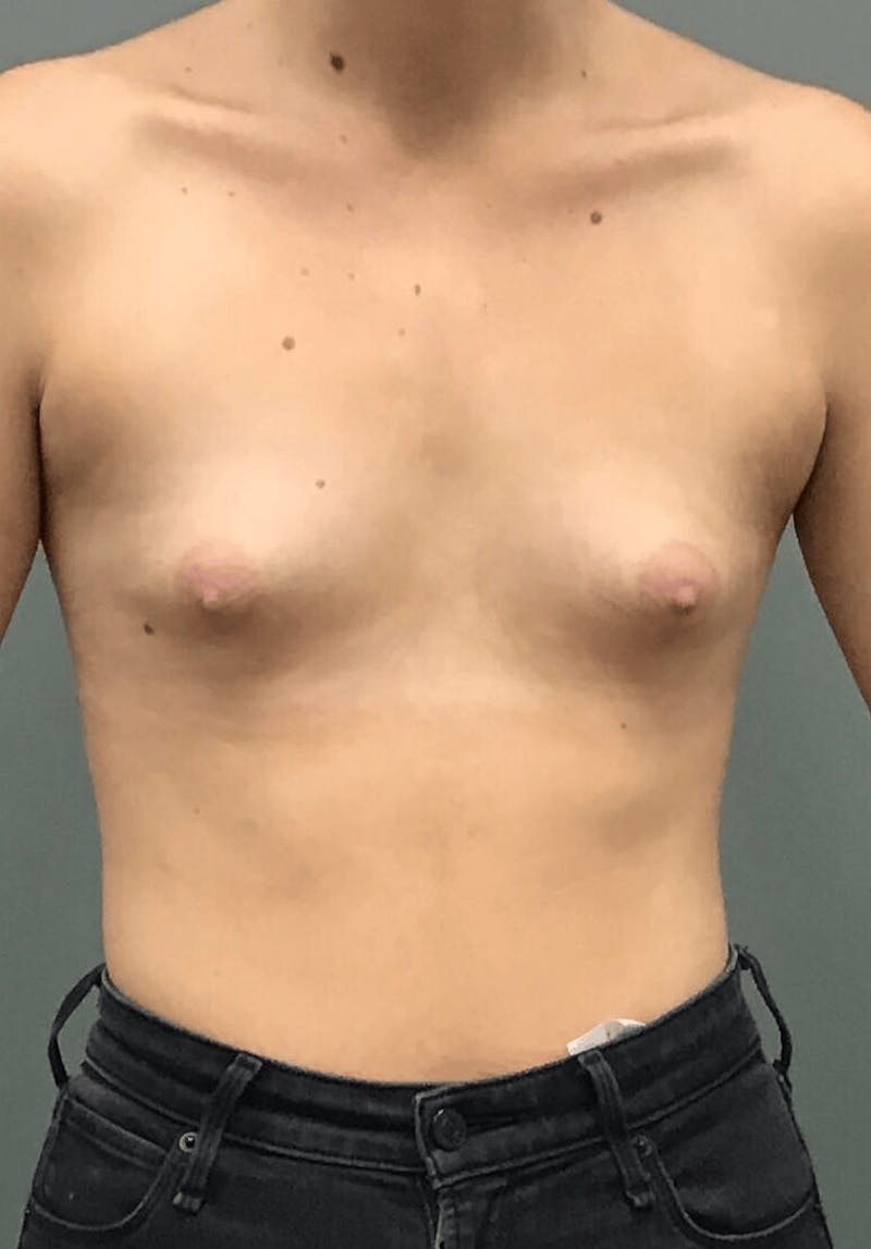 Breast Augmentation Before & After Gallery - Patient 137227 - Image 1