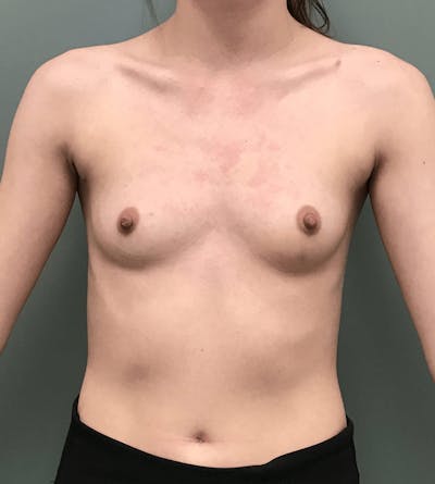 Breast Augmentation Before & After Gallery - Patient 307767 - Image 1