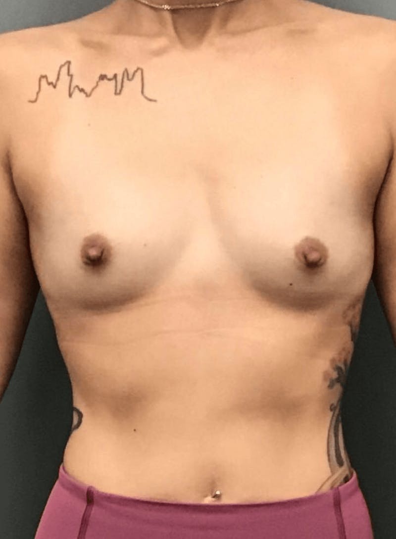 Breast Augmentation Before & After Gallery - Patient 148661 - Image 1